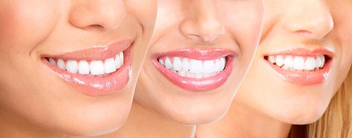 Một số tác hại của việc tẩy trắng răng không đảm bảo 3