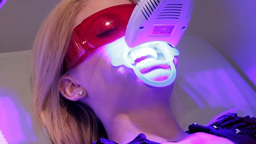 Tẩy trắng răng bằng đèn plasma có hại không với tuổi 16? 3