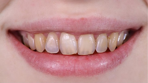Tẩy trắng răng có ảnh hưởng gì không? Cần lưu ý điều gì 2