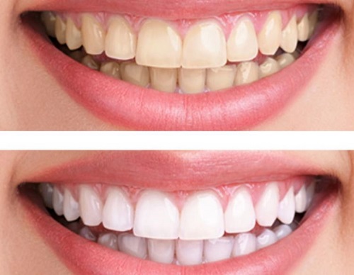 Tẩy trắng răng có ảnh hưởng gì không? Cần lưu ý điều gì 3