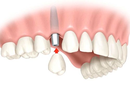 Quá trình cấy ghép implant cho răng cửa bạn nên biết 2