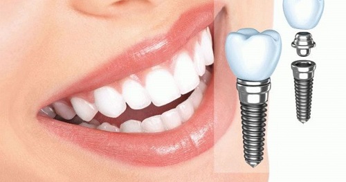 Quá trình cấy ghép implant cho răng cửa bạn nên biết 3