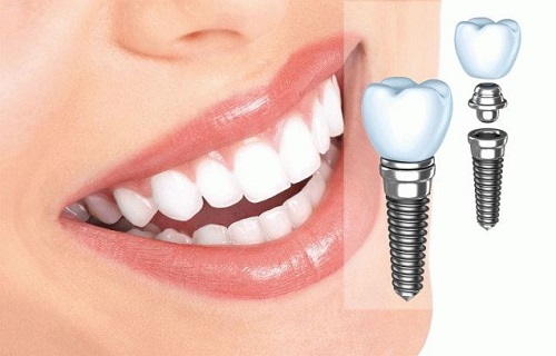Cách chăm sóc răng sau khi cấy implant hiệu quả nhất 1