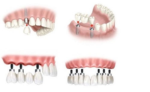 Cách chăm sóc răng sau khi cấy implant hiệu quả nhất 2