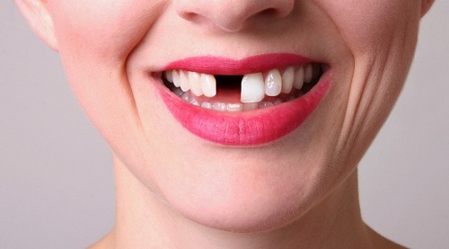 Nên bọc răng sứ hay cấy ghép implant để đạt được kết quả cao? 1