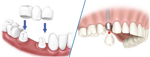 Nên bọc răng sứ hay cấy ghép implant để đạt được kết quả cao? 2