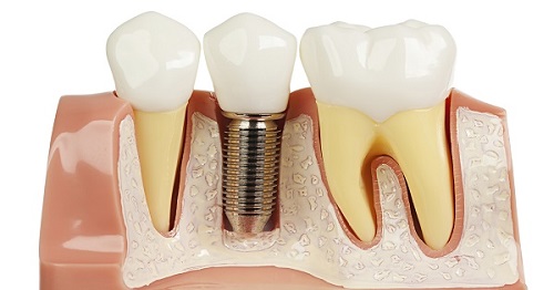 Nên bọc răng sứ hay cấy ghép implant để đạt được kết quả cao? 3