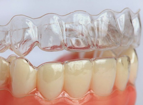 Niềng răng invisalign ở Việt Nam như thế nào? 1