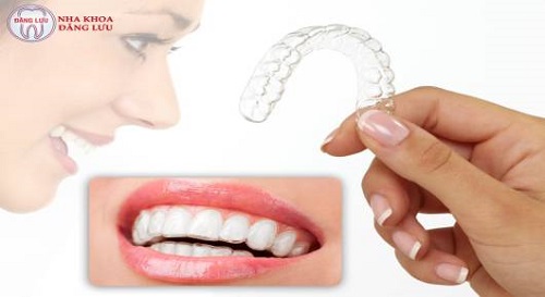 Phương pháp niềng răng không mắc cài 3d clear aligner 1