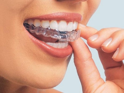 Niềng răng thẩm mỹ bằng nhựa - Các thông tin cần biết 1