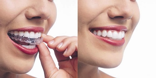 Niềng răng thẩm mỹ bằng nhựa - Các thông tin cần biết 3