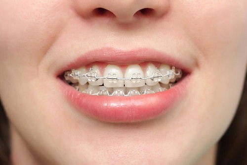 Bị hô hàm răng trên có nên niềng răng không? 1