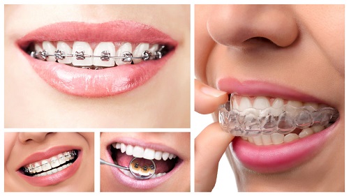 Bị hô hàm răng trên có nên niềng răng không? 2