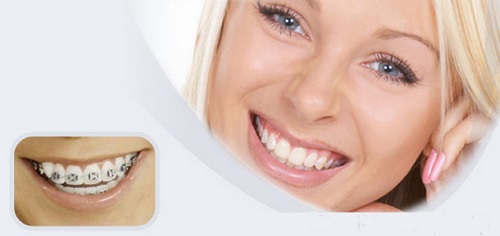 Bị hô hàm răng trên có nên niềng răng không? 3