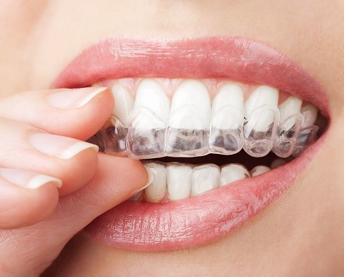 Bị hô hàm răng trên có nên niềng răng không? 4
