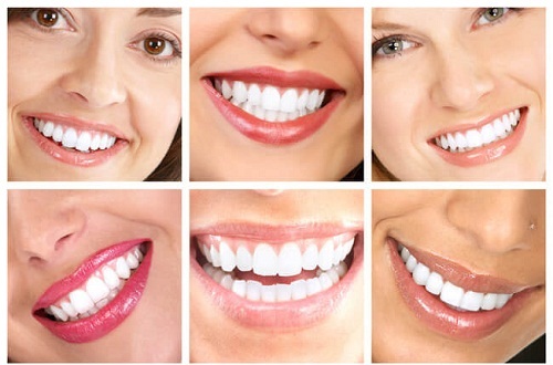 Nên tẩy trắng răng bằng phương pháp nào để đạt hiệu quả cao? 1