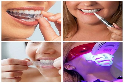 Nên tẩy trắng răng bằng phương pháp nào để đạt hiệu quả cao? 2