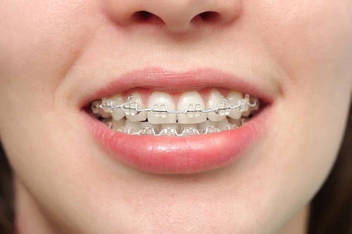 Niềng răng có phải nhổ răng không đối với răng hô? 1