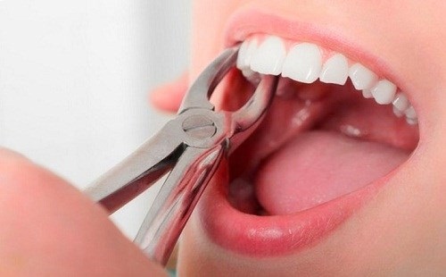 Niềng răng có phải nhổ răng không đối với răng hô? 2