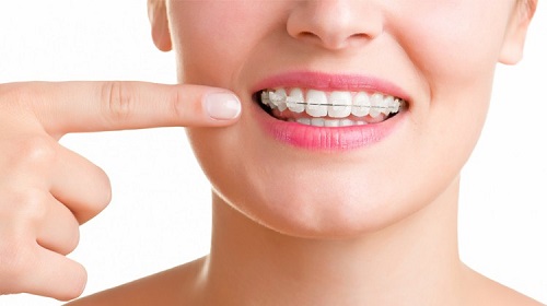 Niềng răng mắc cài sứ có đau không với răng móm hàm dưới? 1