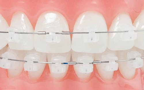 Niềng răng mắc cài sứ có đau không với răng móm hàm dưới? 2