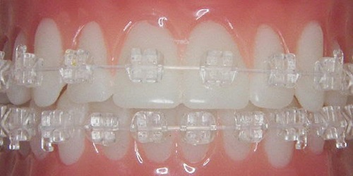 Niềng răng mắc cài sứ dây trong là phương pháp gì? 1