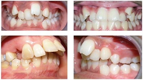 Niềng răng mắc cài sứ dây trong là phương pháp gì? 2