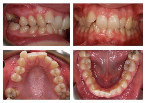 Niềng răng mặt trong mất bao lâu là hoàn chỉnh? 3