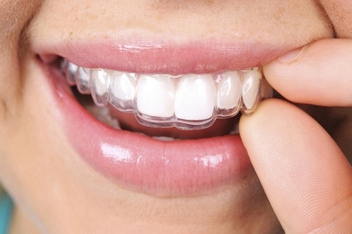 Niềng răng trong suốt mất bao lâu thì răng đều hẳn? 1