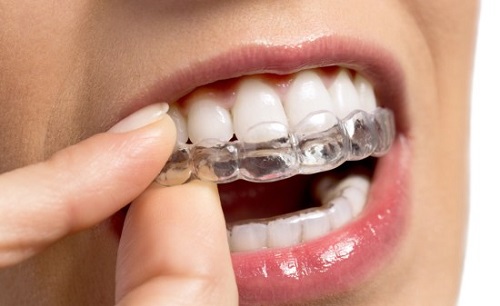 Niềng răng trong suốt mất bao lâu thì răng đều hẳn? 2