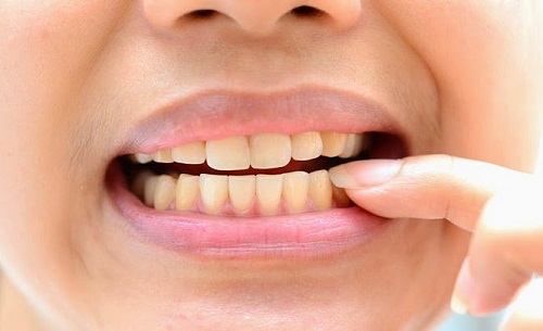 Phương pháp nào giúp tẩy trắng răng nhiễm tetra hiệu quả? 1