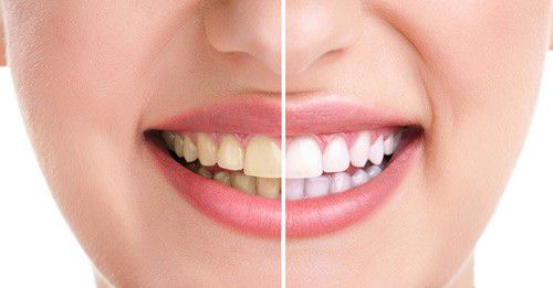 Phương pháp nào giúp tẩy trắng răng nhiễm tetra hiệu quả? 2