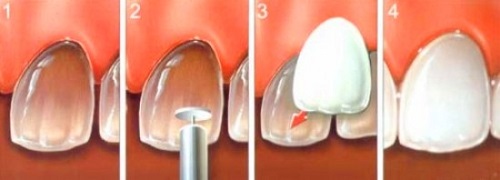 Phương pháp nào giúp tẩy trắng răng nhiễm tetra hiệu quả? 3