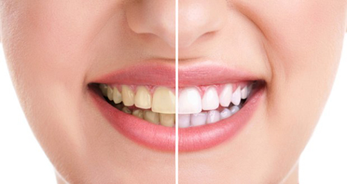 3 cách tẩy trắng răng tại nhà cực kỳ an toàn cho bạn 1