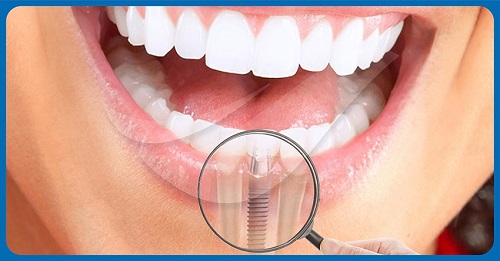 Cần tư vấn trồng răng có đau không? 3