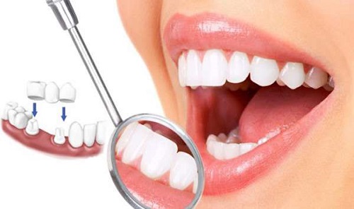 Bọc răng sứ có nguy hiểm không với người dưới 18 tuổi? 1