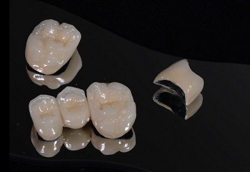 Bọc răng sứ kim loại có bền không? Kéo dài bao lâu? 1