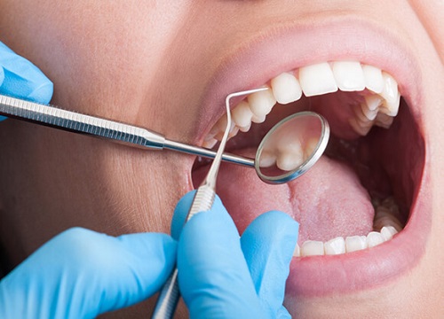 Bọc răng sứ là gì? Quy trình thực hiện dịch vụ này 3