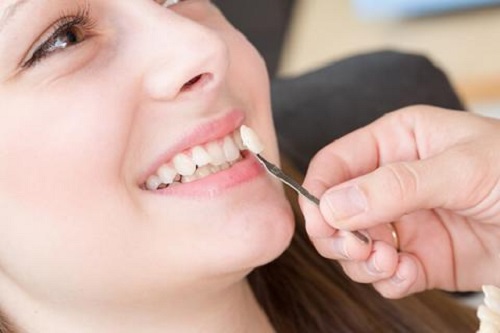 Dán răng sứ có bền không? Duy trì tốt nhất bao lâu?