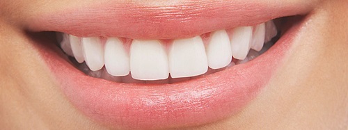 Dán sứ cho răng thưa cho hàm răng khít đều tự nhiên 1