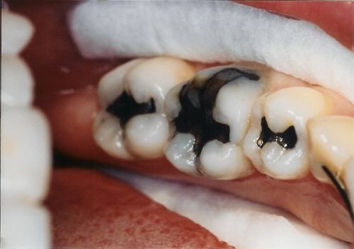 Thực hiện tẩy trắng răng cho răng sâu có được không? 3