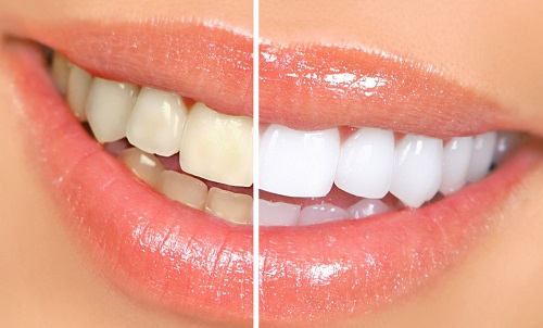 Theo bạn có nên tẩy trắng răng nhiều lần không? 3