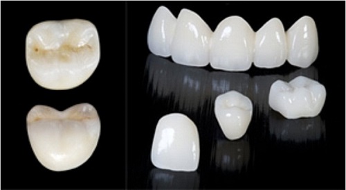 Độ bền của răng sứ thẩm mỹ như thế nào? 2
