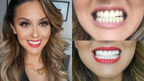 Độ bền của răng sứ thẩm mỹ như thế nào? 3
