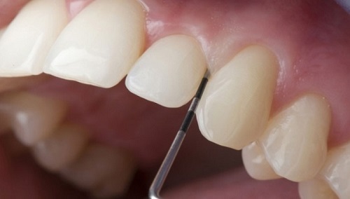 Làm răng sứ cả hàm được áp dụng khi nào?