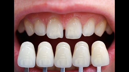 Làm răng sứ cả hàm được áp dụng khi nào? 3