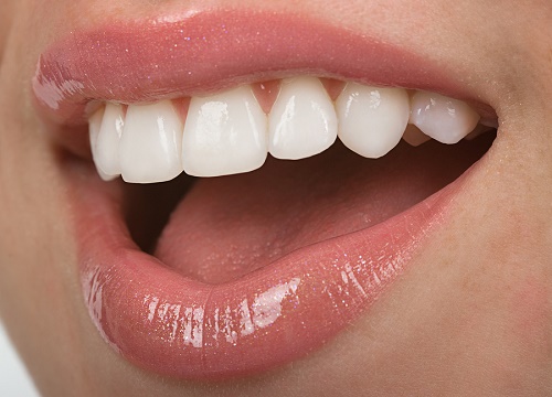 Làm răng sứ có niềng răng được không? Phân tích từ bác sĩ 1