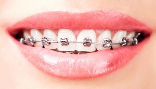 Làm răng sứ có niềng răng được không? Phân tích từ bác sĩ 2