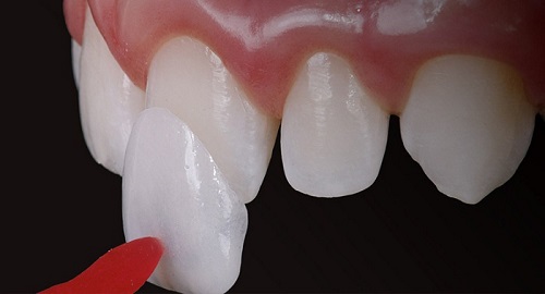 Làm răng sứ không mài răng cho trường hợp nào?