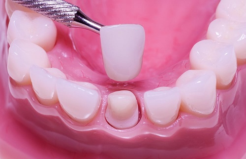 Làm răng sứ mất bao lâu? Cách nào rút ngắn thời gian? 1